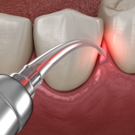 Illustrated dental laser treating the gums