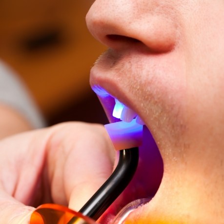 Close up of dental patient getting cosmetic bonding on upper front tooth