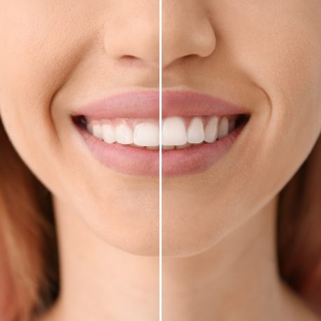 Close up of woman smiling before and after gummy smile correction