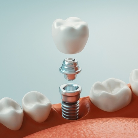 Illustrated dental implant with crown and abutment being placed into lower jaw
