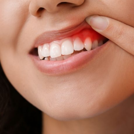 Close up of person pointing to red spot in their gums