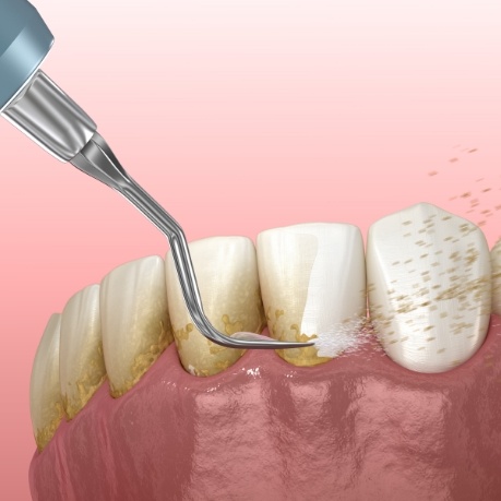 Illustrated dental scaler cleaning plaque buildup from teeth