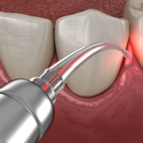 Illustrated dental laser treating the gums