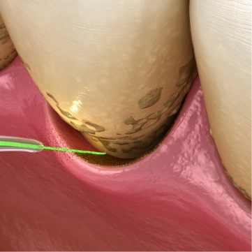 Illustrated dental laser removing plaque from teeth
