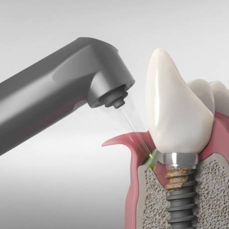 Illustrated dental instrument treating gum disease near a dental implant