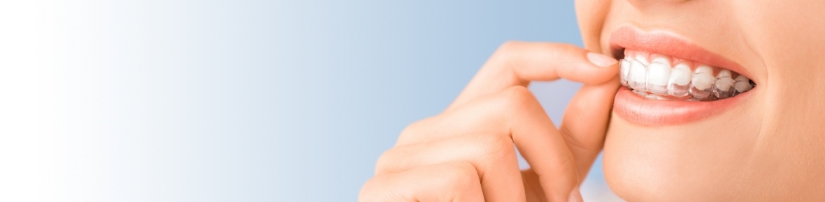 Close up of person placing an Invisalign clear aligner in their mouth