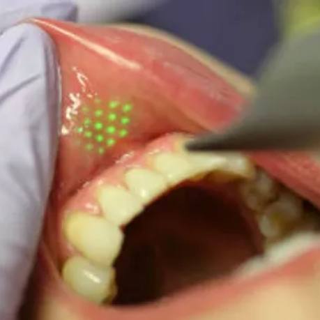 Dental patient having green light shone onto inside of lower lip