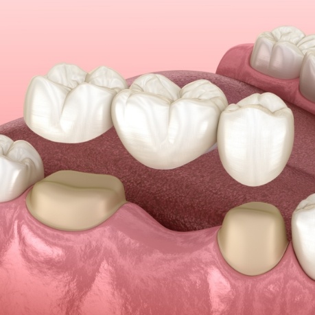 Illustrated dental bridge being placed