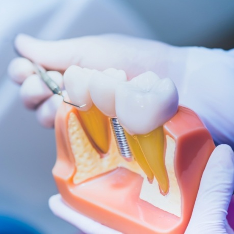 Dentist holding a model of a dental implant