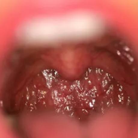 CLose up of soft tissues in back of throat