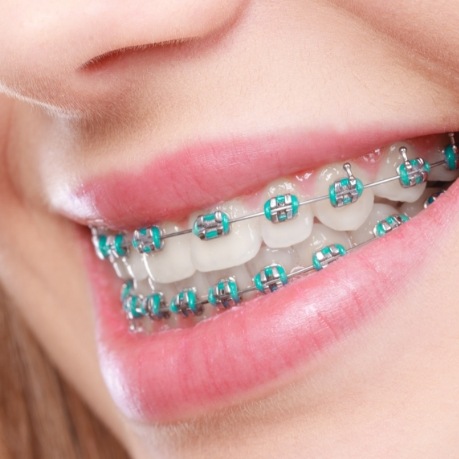 Close up of person smiling with traditional braces