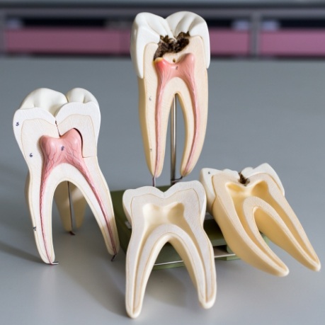 Four models of teeth showing root canal layers inside of them
