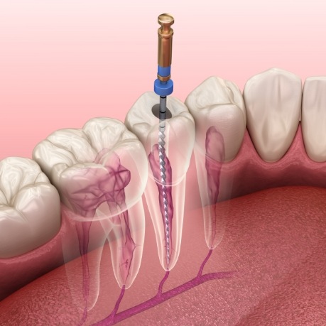 Illustrated dental instrument cleaning the inside of a tooth