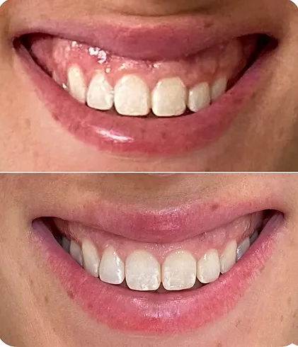 Close up of smile before and after laser gingivectomy and Botox