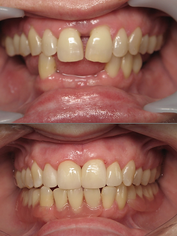 Smile before and after treatment with ceramic crowns and a partial denture