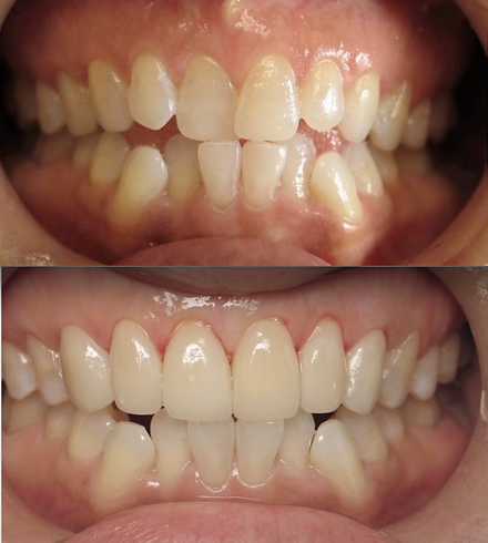 Smile before and after treatment with six ceramic dental crowns