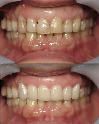 Smile before and after ceramic crowns and laser root canal treatment