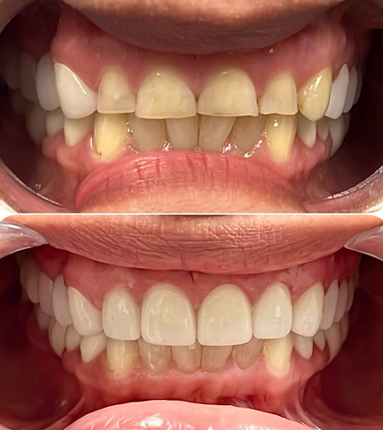 Smile before and after getting six dental crowns and a gingivectomy