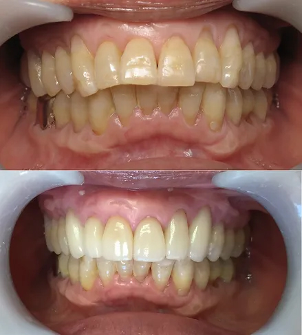 Smile before and after restoring six teeth with dental crowns
