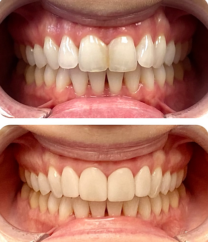 Smile before and after restoring four teeth with dental crowns