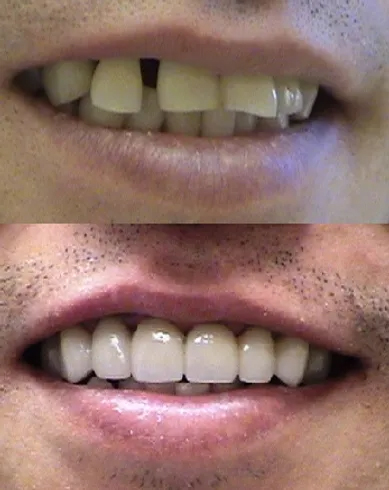 Smile before and after six dental crowns and gum disease treatment