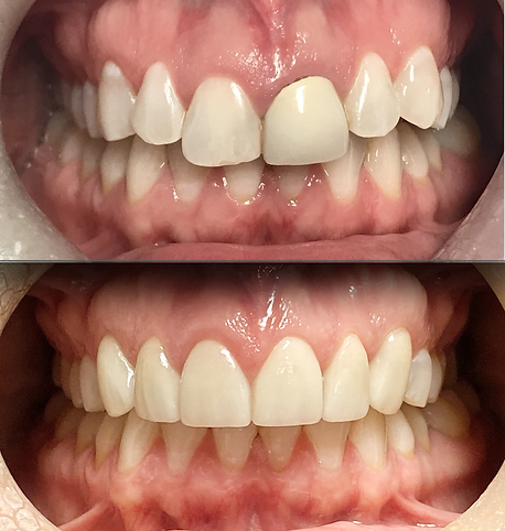 Smile before and after laser gingivectomy and six ceramic dental crowns