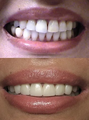 Smile before and after ceramic veneers a crown and a bridge