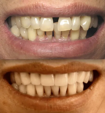 Smile before and after gum disease treatment and ceramic crowns