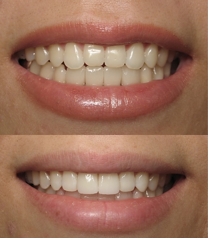 Close up of smile before and after treatment with ceramic veneers