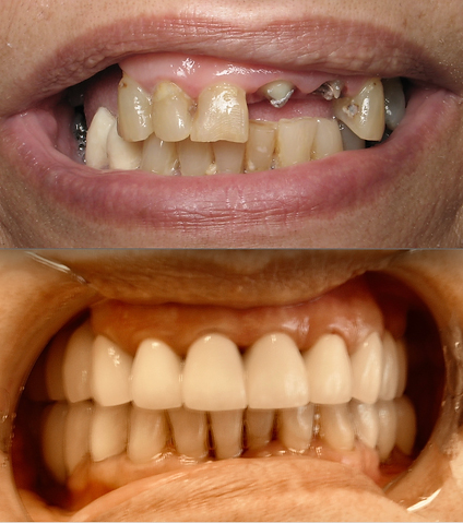 Smile before and after gum disease treatment and ceramic crowns and bridges