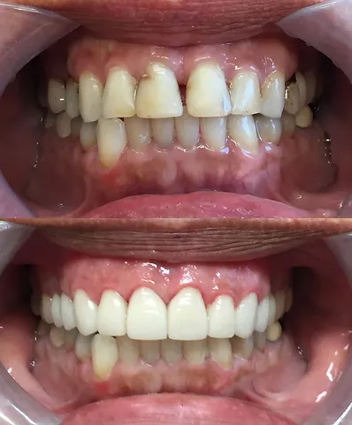 Smile before and after ten dental crowns and laser gingivoplasty