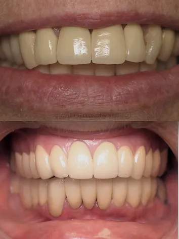 Smile before and after gum disease treatment and ceramic crowns on all teeth