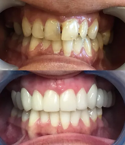 Smile before and after periodontal treatment and ceramic crowns and bridges