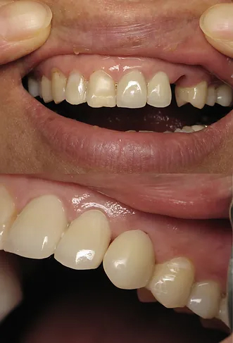 Smile before and after dental implant with crown
