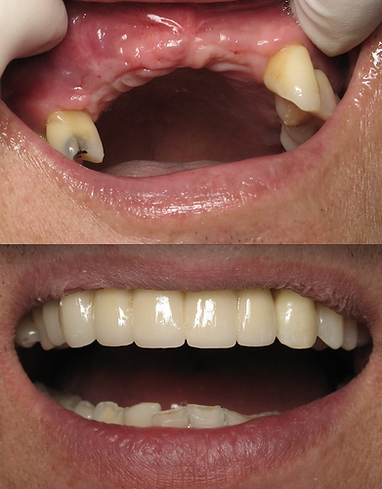 Smile before and after getting dental implant bridge