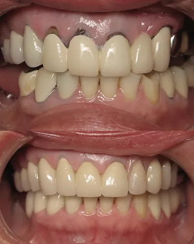 Smile before and after implant partial denture and ceramic crowns