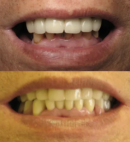 Smile before and after implant partial dentures and ceramic crowns