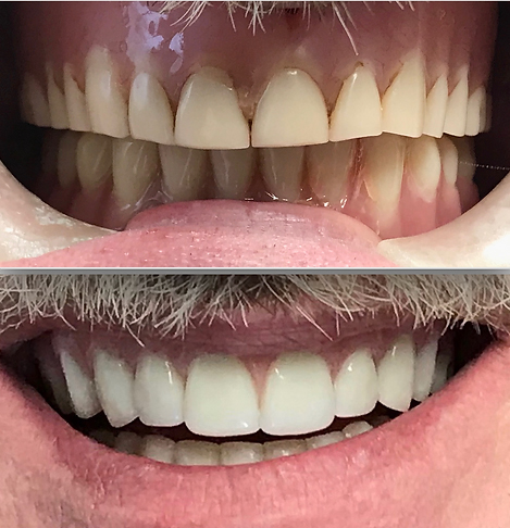 Smile before and after full implant dentures