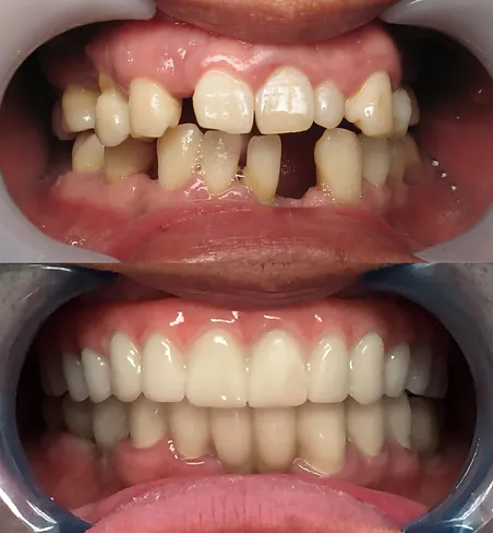 Smile before and after replacing missing teeth with implant dentures crowns and bridges