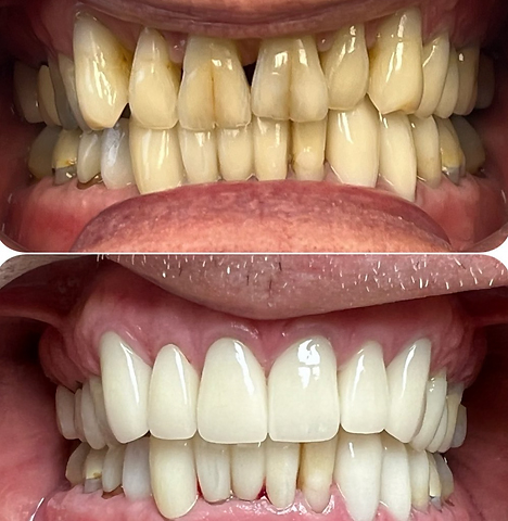 Smile before and after getting ceramic veneers on six upper teeth