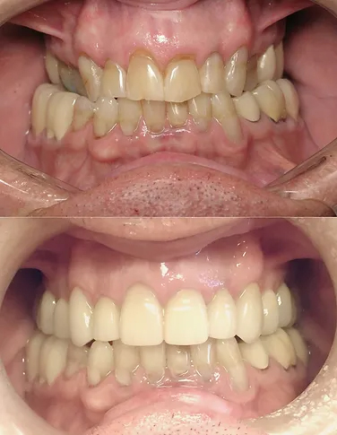 Smile before and after T M J treatment