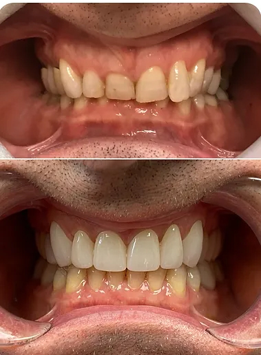 Smile before and after Invisalign and T M J treatment