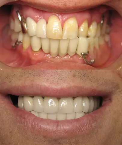 Smile before and after multidisciplinary dentistry and T M J treatment
