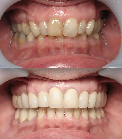 Smile before and after multidisciplinary dentistry and T M J treatment