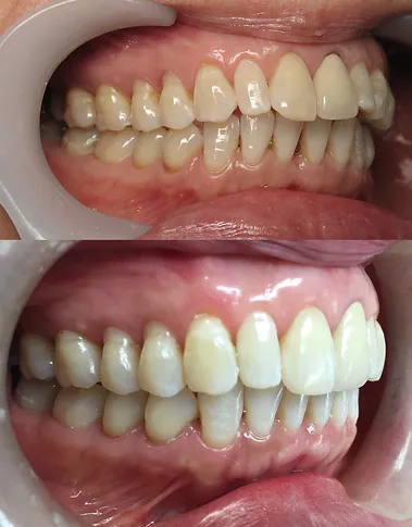 Smile before and after Invisalign and multidisciplinary dentistry