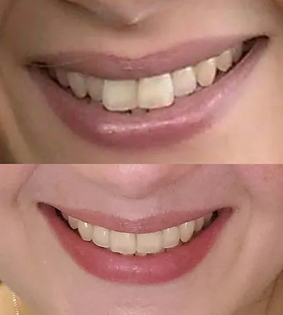 Smile before and after Invisalign treatment