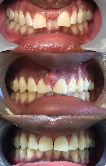 Smile before and after laser frenectomy and Invisalign