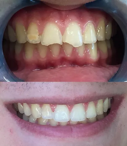 Smile before and after white fillings