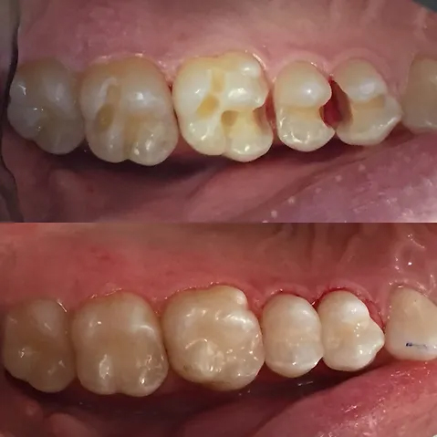 Smile before and after resin restorations