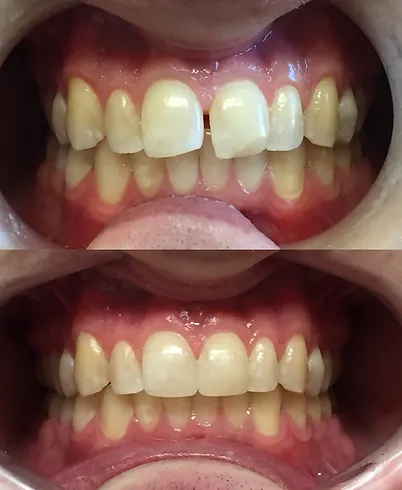Smile before and after composite veneers
